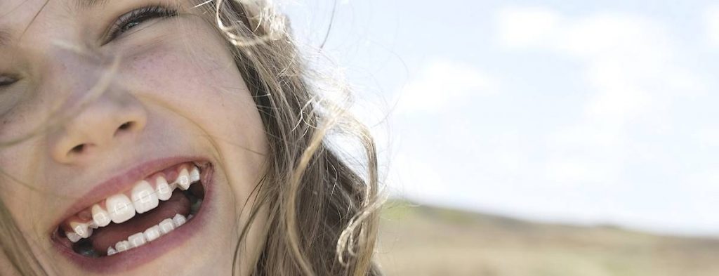 Clarity clear ceramic braces