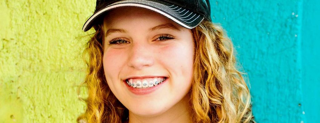 How Braces Have Changed